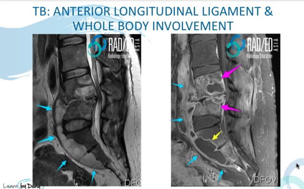 Is it TB? : What does spinal TB look like on MRI - Radedasia