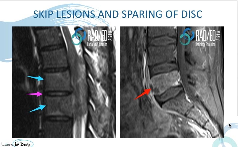 mri spine tb tuberculosis discitis epidural abscess radiology education asia skip lesions spared disc