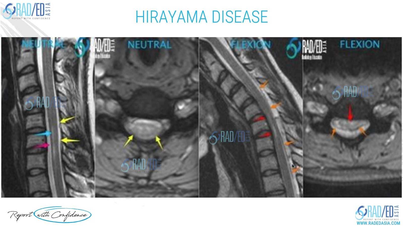 hirayama disease mri spine mri online radiology course radedasia