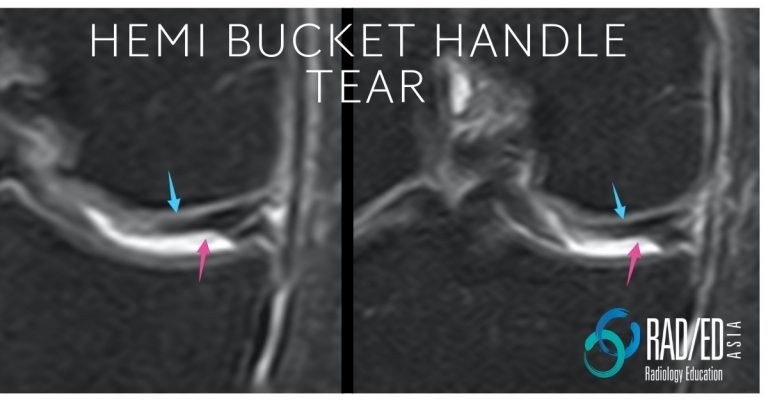 Hemi Bucket Handle Tear Knee Mri Radedasia