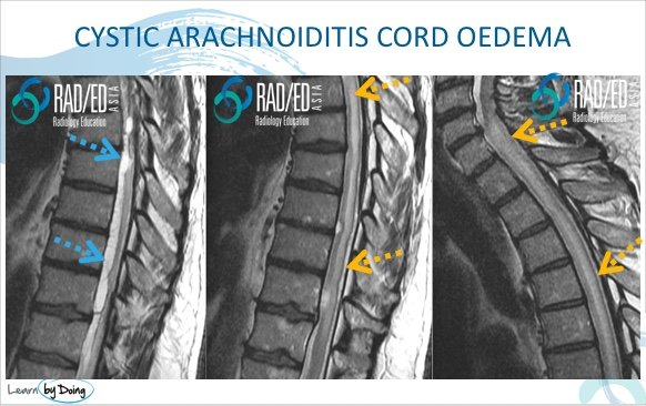 cystic arachnoiditis cord compression oedema mri radiology education asia
