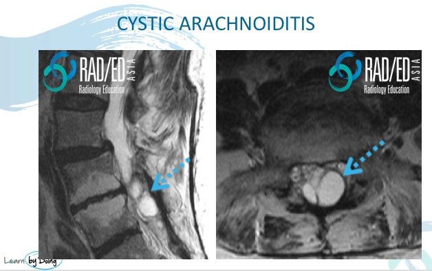 cystic arachnoiditis mri radiology education asia