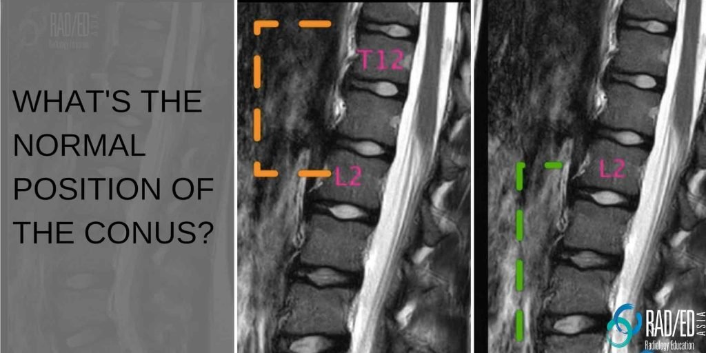 mri spine normal position conus tethered radiology education asia radedasia