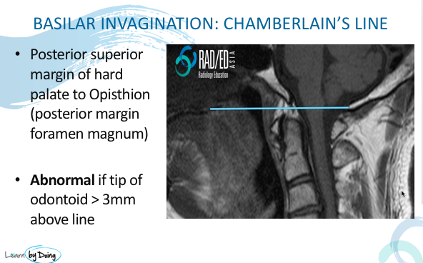 mri spine rheumatoid arthritis basilar invagination radedasia radiology education fellowship 04