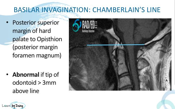 Basilar Invagination Measurement