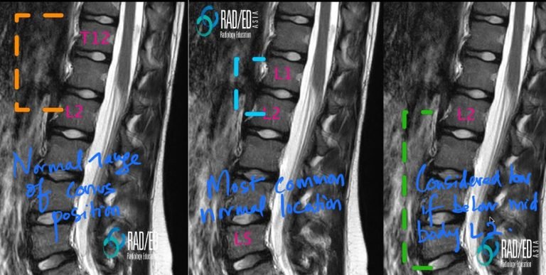 spine mri normal position conus tethered radiology education asia
