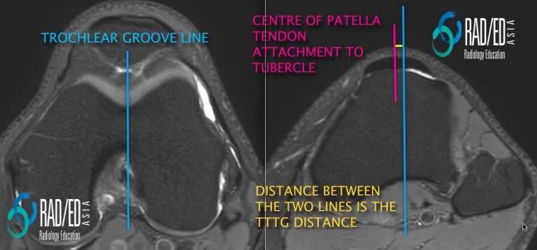 knee patella dislocation tibial tuberosity