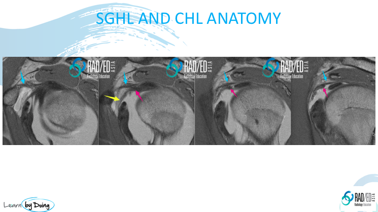 mri gleno humeral ligaments shoulder radiology education asia