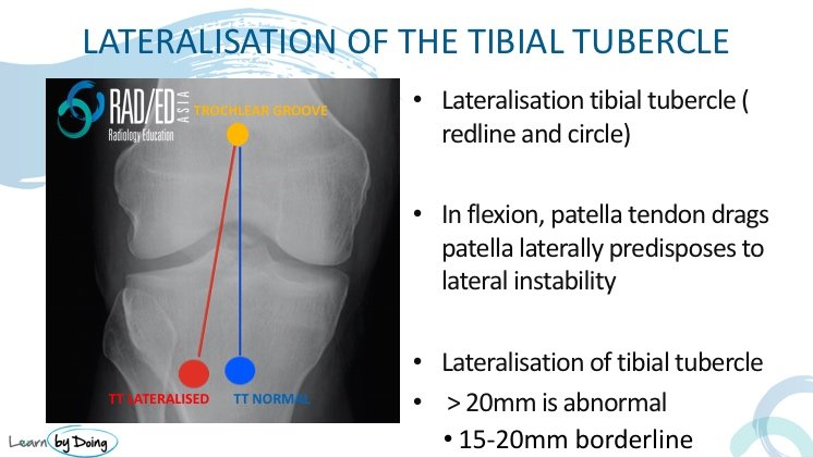 patella dislocation mri lateralisation tibial tubercle radiology education asia
