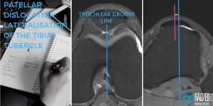 patellar dislocation lateralisation tibial tubercle radiology education asia