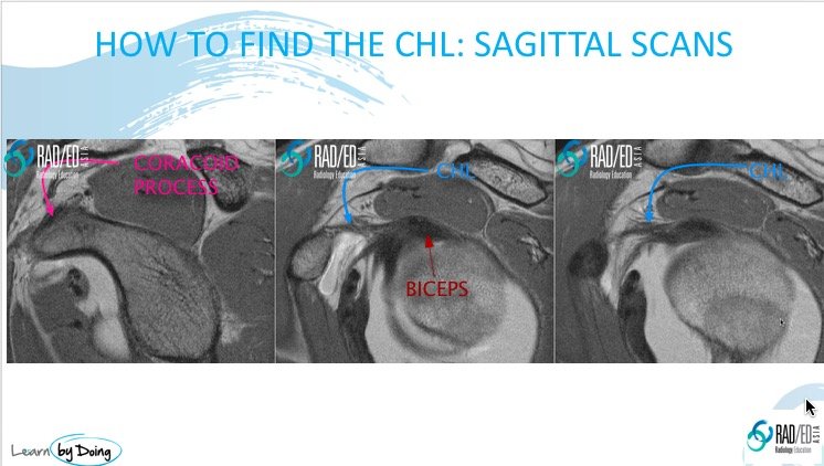 coracohumeral ligament mri