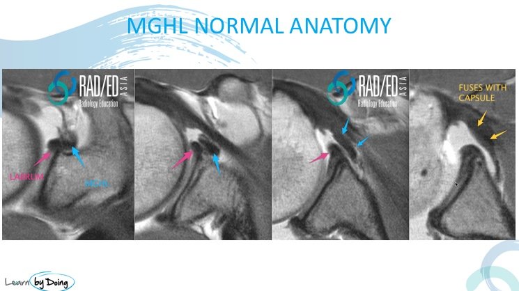 shoulder mghl gleno humeral ligaments mri radiology education asia