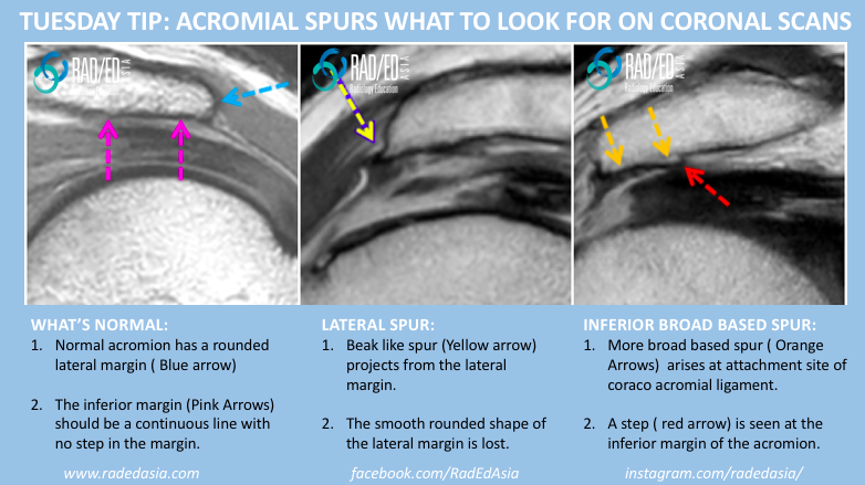 ACROMIAL ACROMION SPUR MRI RADIOLOGY: HOW TO FIND ON CORONAL SCANS ...