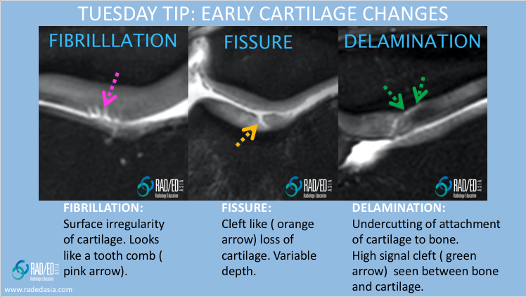 mri cartilage delamination radiology education asia