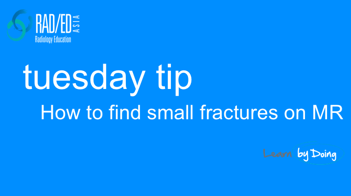 mri fracture how to find tuesday tip radiology education asia