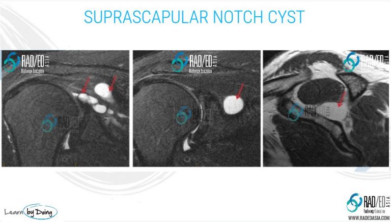 mri shoulder denervation parsonage turner syndrome infraspinatus supraspinatus paralabral cyst radiology education asia