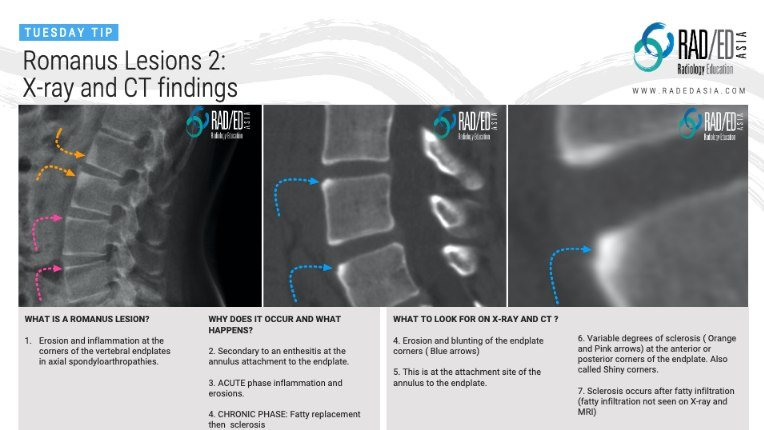 ROMANUS LESIONS X-RAY CT FINDINGS CORNER INFLAMMATORY LESION - Radedasia