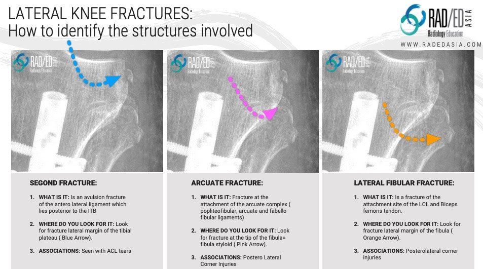 arcuate segond fracture fibular styloid radiology education asia