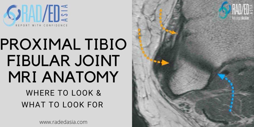 proximal tibiofibular joint ligament anatomy mri