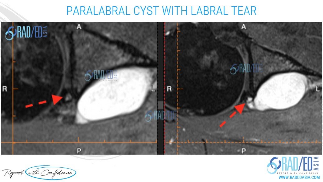 ols 14 case 2 paralabral cyst with labral tear radedasia