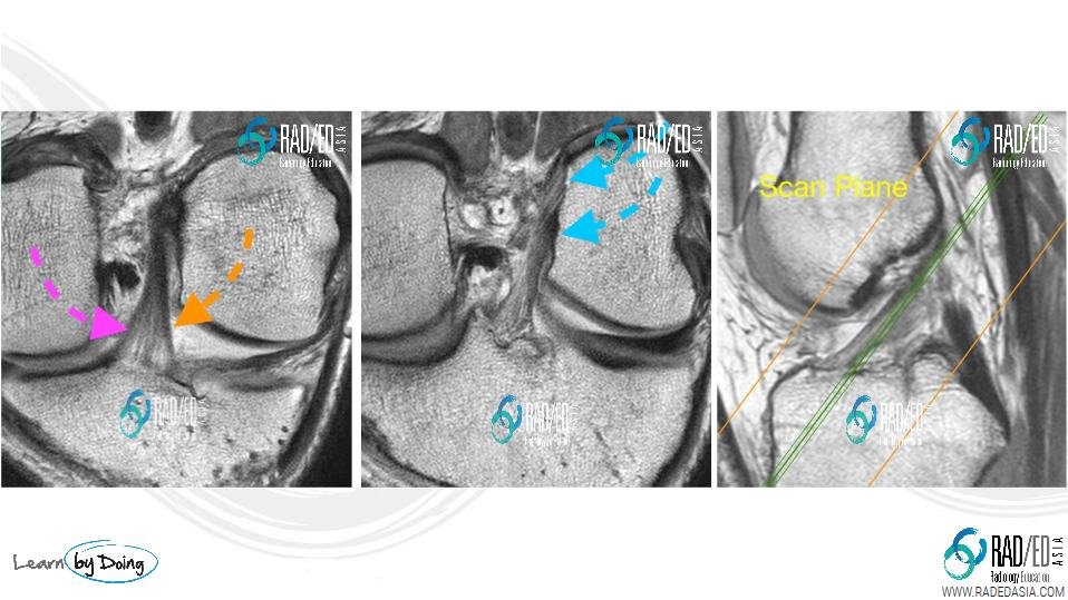 coronal-oblique-acl-bands1-mri-radedasia