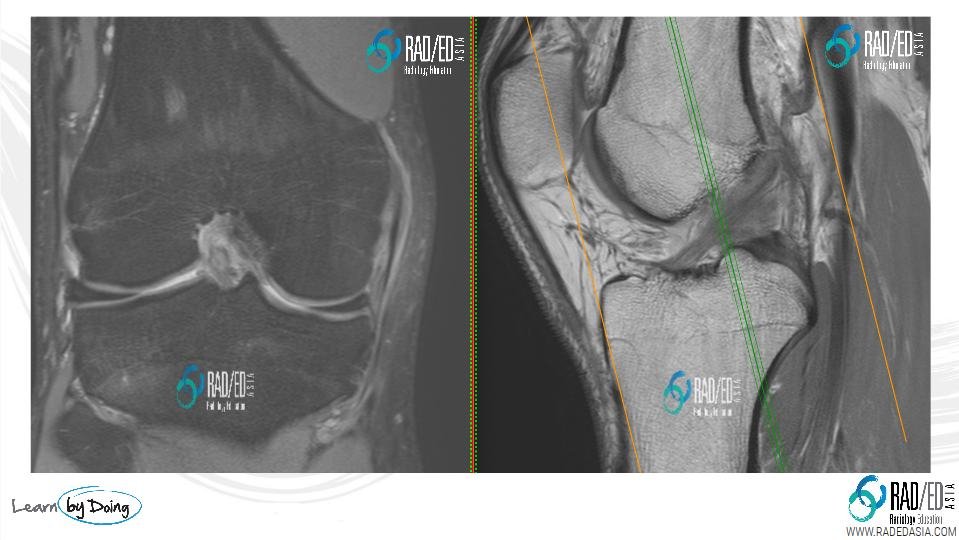 coronal-oblique-acl-bands2-mri-radedasia