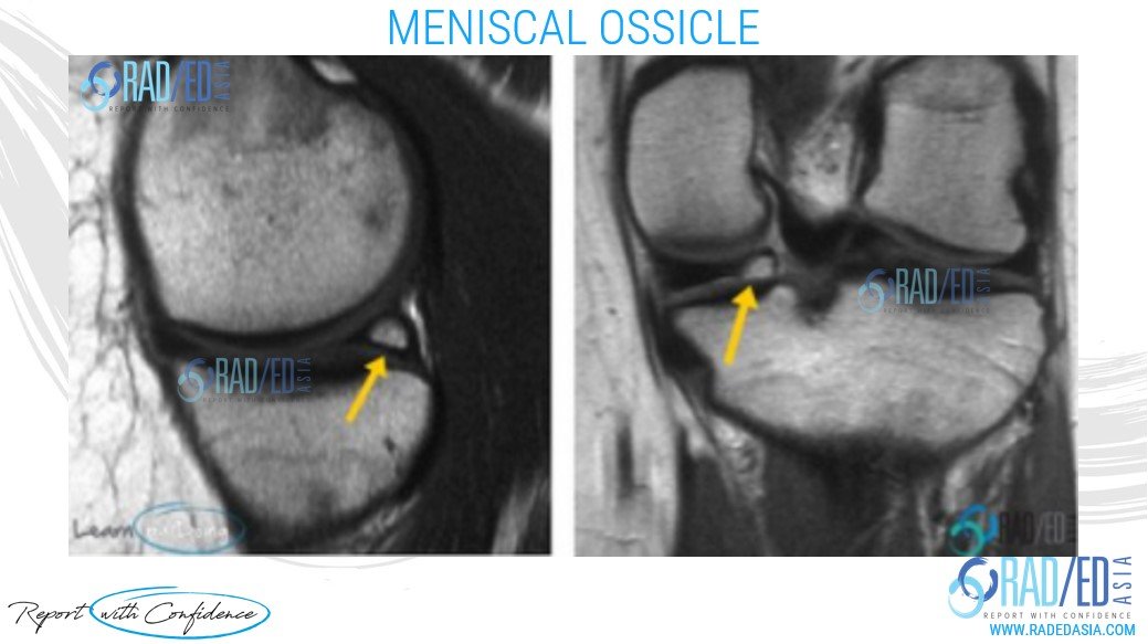 olk 08 meniscal ossicle radedasia