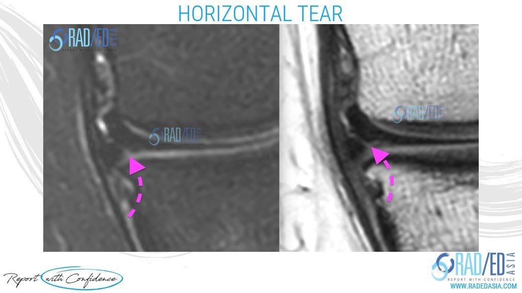 olk 3.1 case 1 K002 horizontal tear radedasia