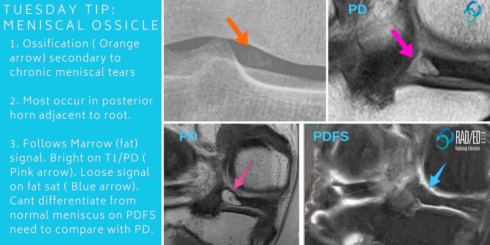olk-meniscal-ossicle-1