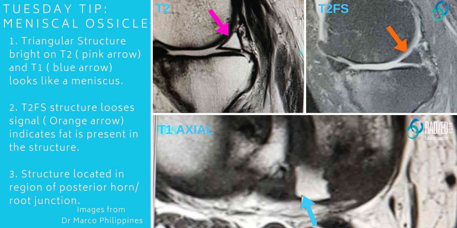 olk-meniscal-ossicle-2