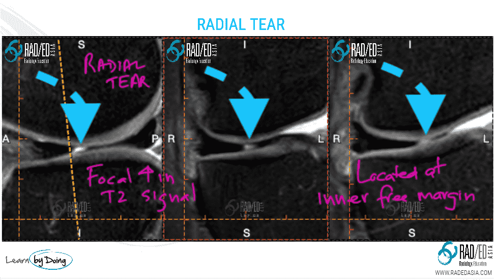 radedasia-radial-tear