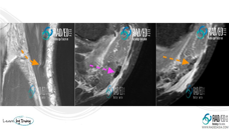 Rupture-and-retraction-biceps-femoris-radedasia