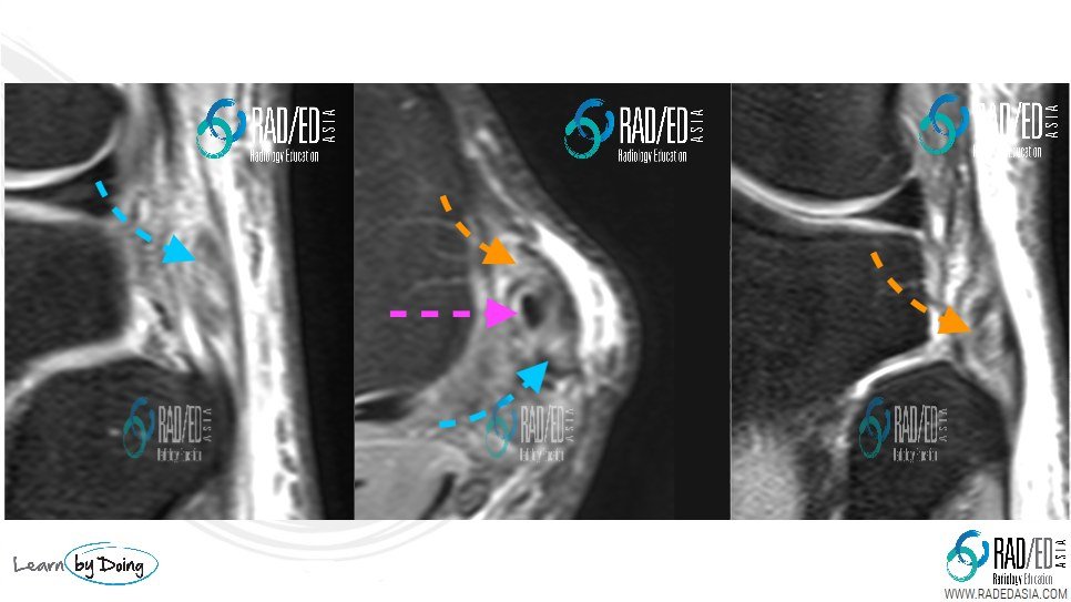 Severe-Partial-tear-Biceps-Femoris-mri-radedasia