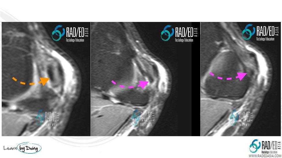 lcl-minimal-tear-mri-radedasia