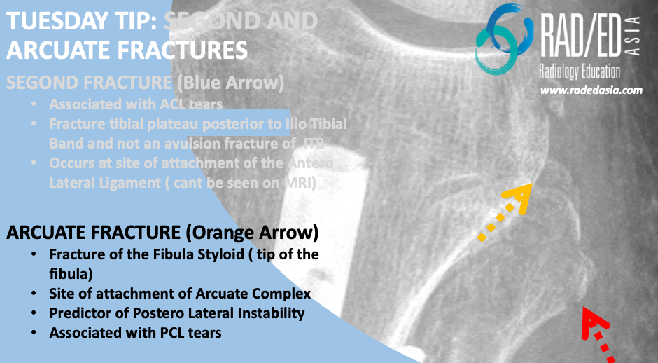 segond-and-arcuate-fractures-mri-radedasia