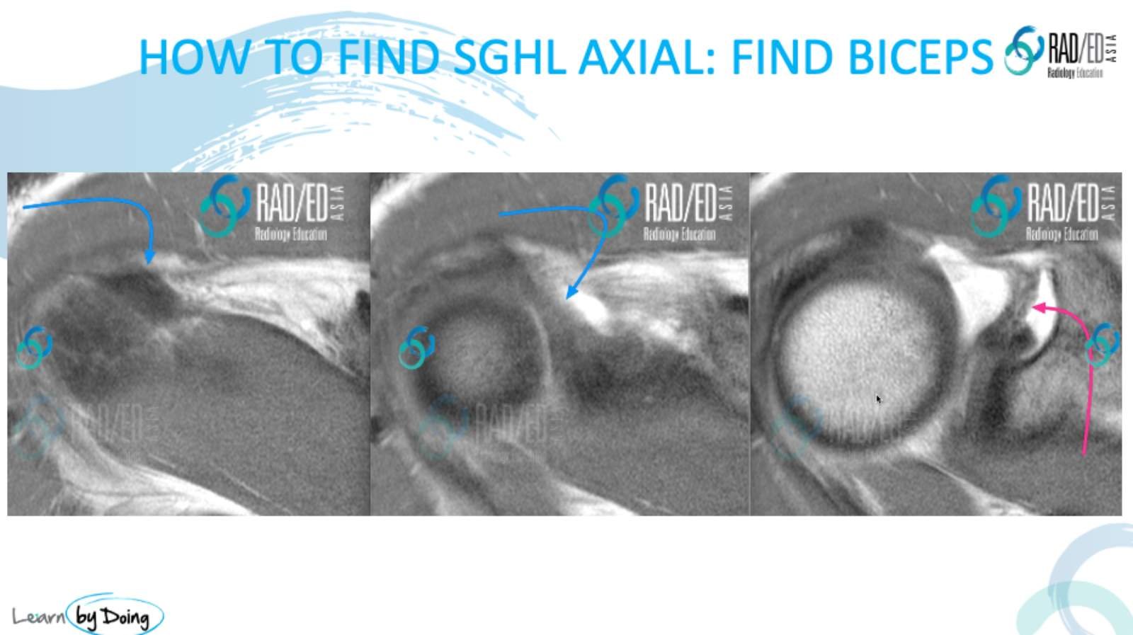 sghl superior glenohumeral ligament axial scan biceps shoulder radiology radedasia