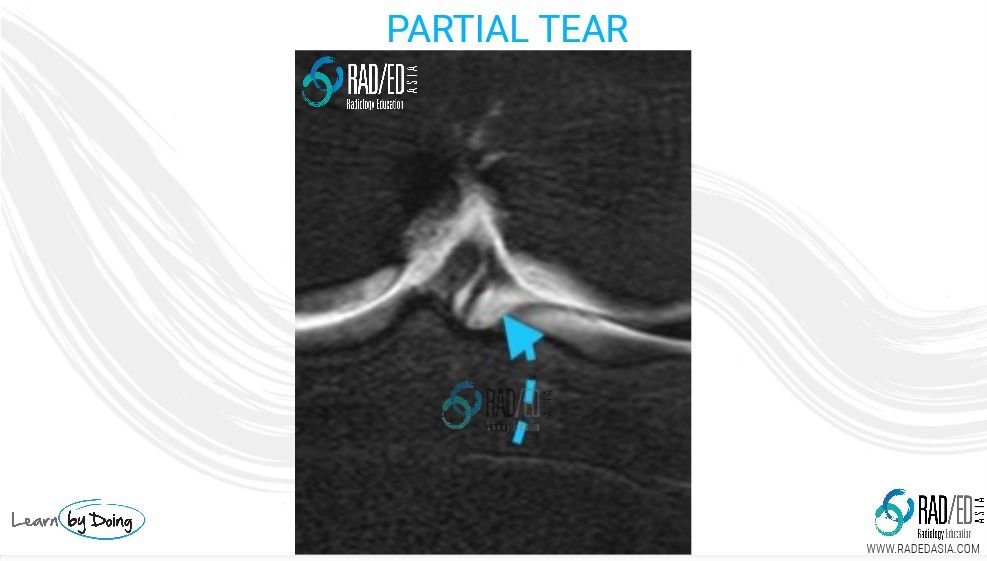 olk-13.1-partail-tear-tib-attach-knee-MRI-rea