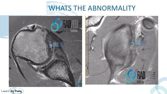 SQ11 shoulder quiz radedasia
