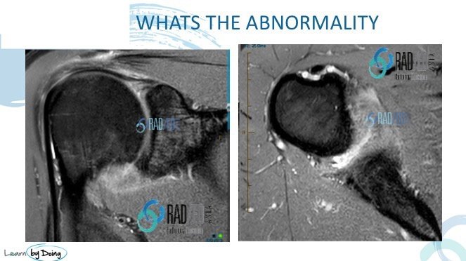 SQ12 shoulder quiz radedasia