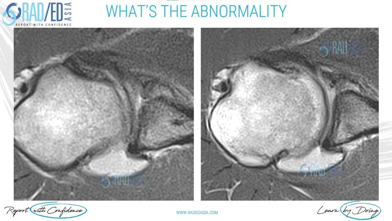 SQ14 quiz shoulder mri radedasia
