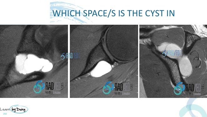 SQ15 shoulder quiz radedasia