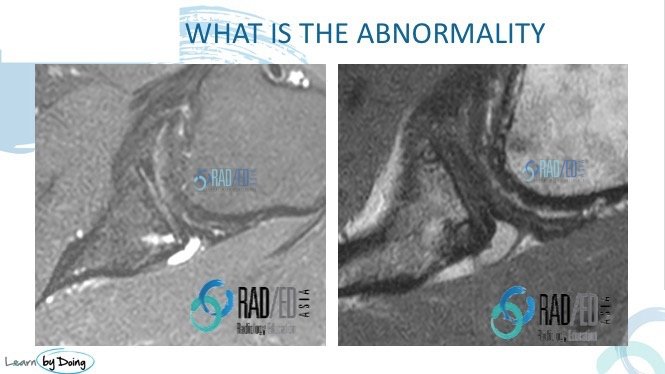 SQ16 shoulder quiz radedasia