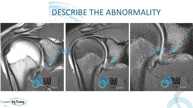 SQ17 shoulder quiz radedasia