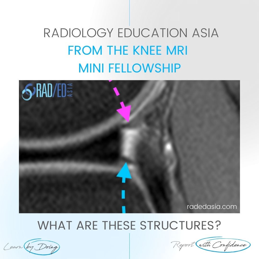 learn knee popliteomeniscal fasicles normal radedasia