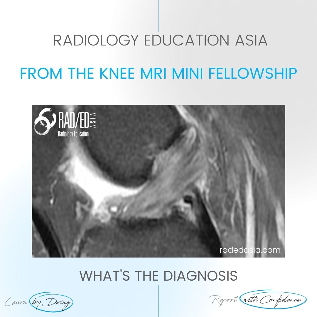 learn mri knee mucoid degen radedasia