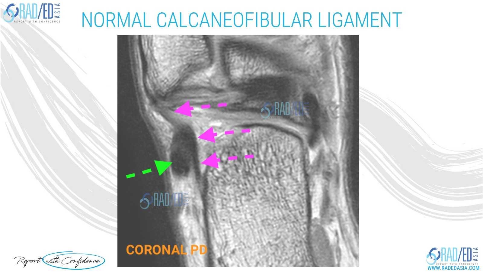 calcaneofibular ligament mri ankle normal