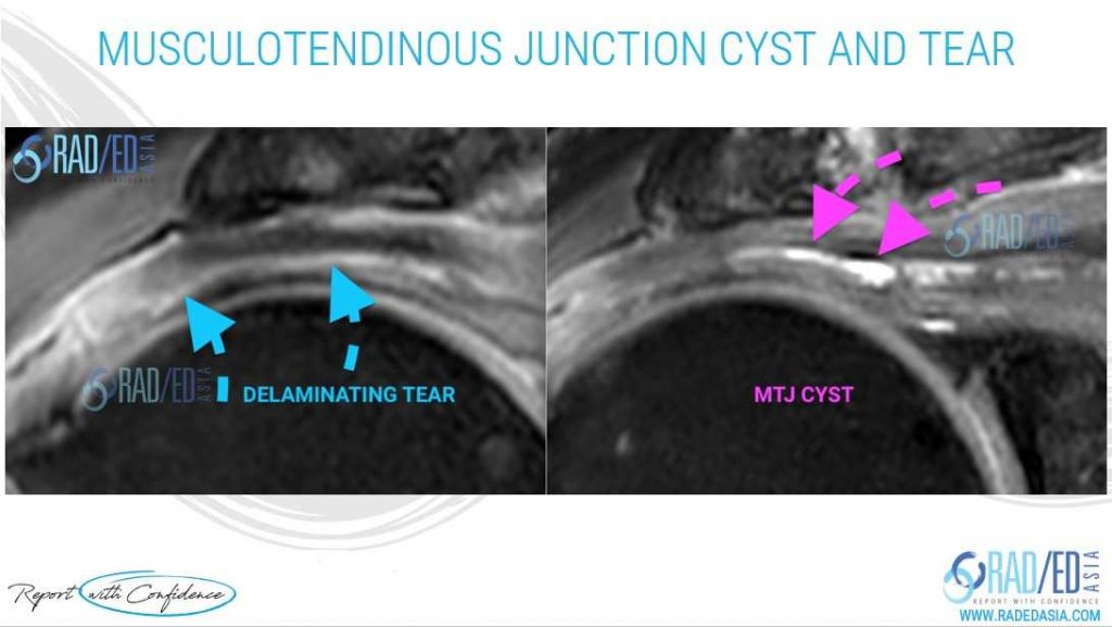 Mri Musculotendinous Junction Cysts And Delaminating Rotator Cuff Tears