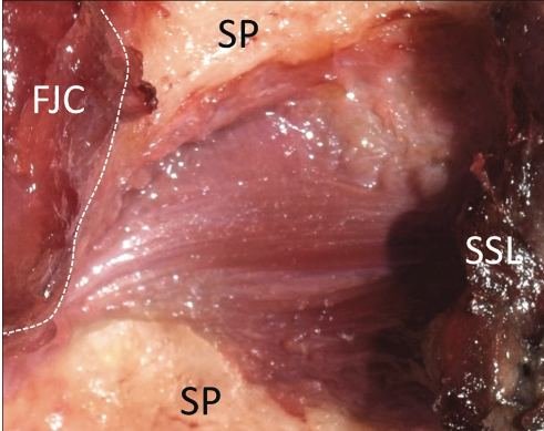 SP Spinous Process, SSL Supraspinous Ligament FJC Facet Joint Capsule