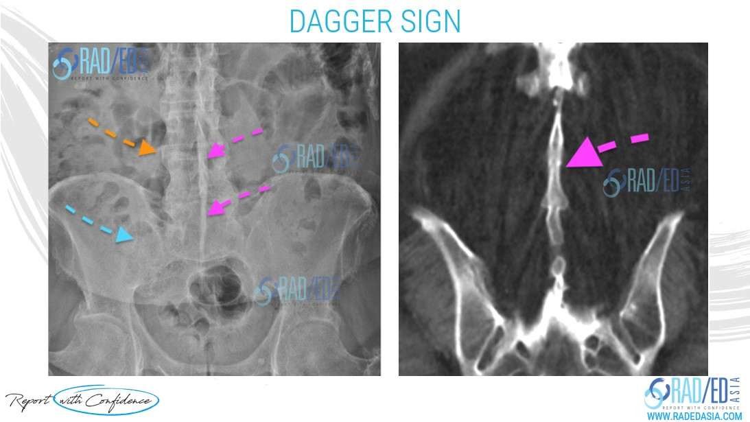 ankylosing spondylitis dagger sign trolley track sign spine fusion imaging radiology xray ct mri