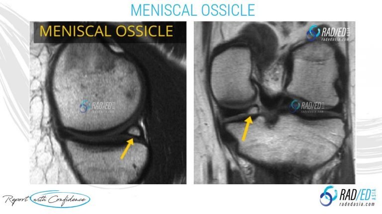 MENISCAL OSSICLES MRI: POSTERIOR HORN MENISCUS (Updated 2021) - Radedasia